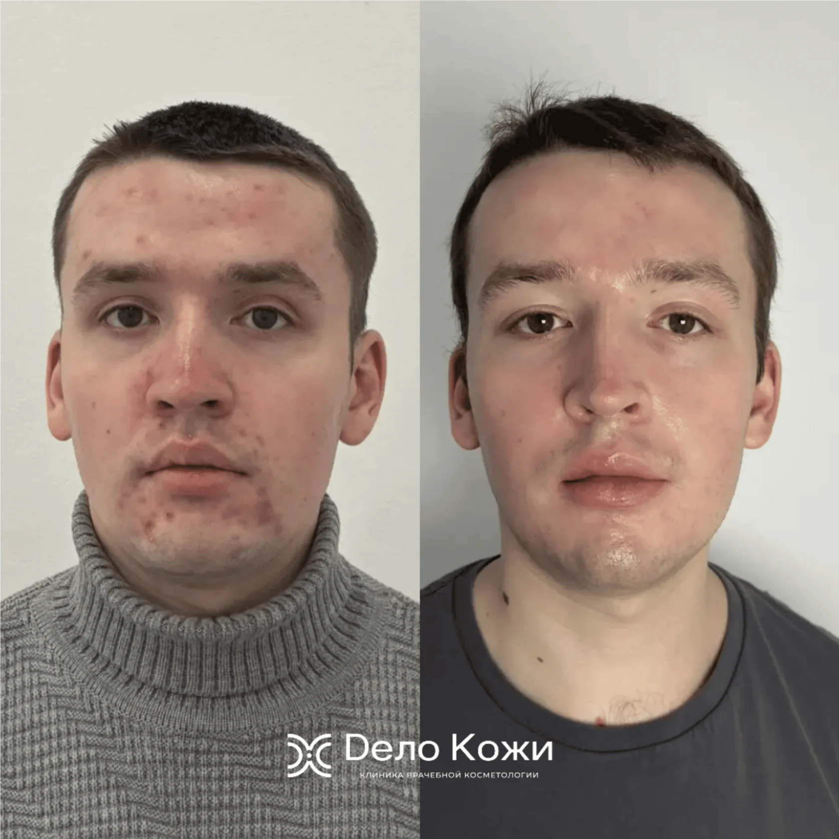 Постакне